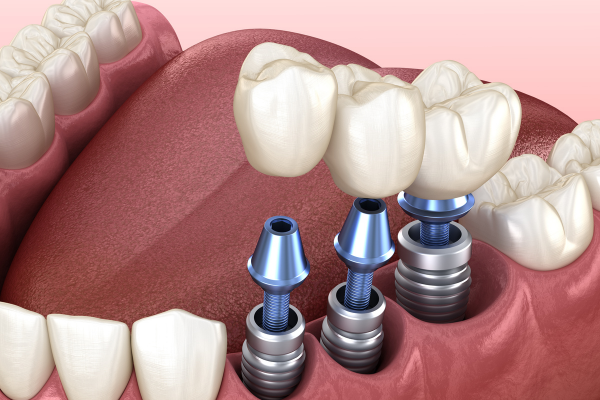 Зубная имплантация: что это и какие плюсы и минусы